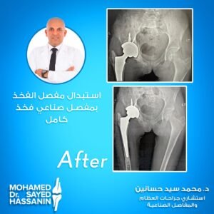 استبدال مفصل الفخذ بعد العملية