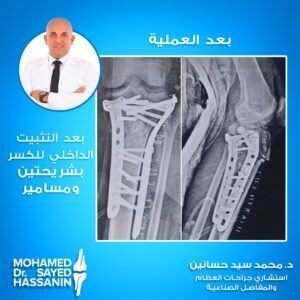 بعد التثبيت الداخلي للكسر بشريحتين ومسامير