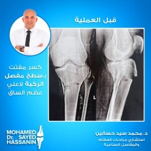 كسر مفتت بسطح مفصل الركبة لاعلي عظم الساق قبل العملية